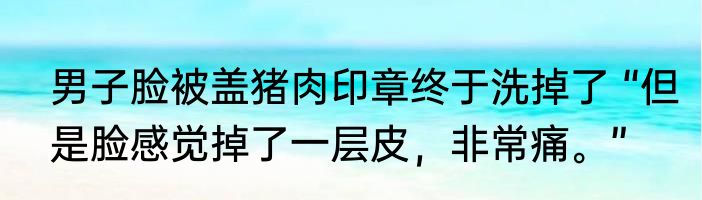 男子脸被盖猪肉印章终于洗掉了 “但是脸感觉掉了一层皮，非常痛。”